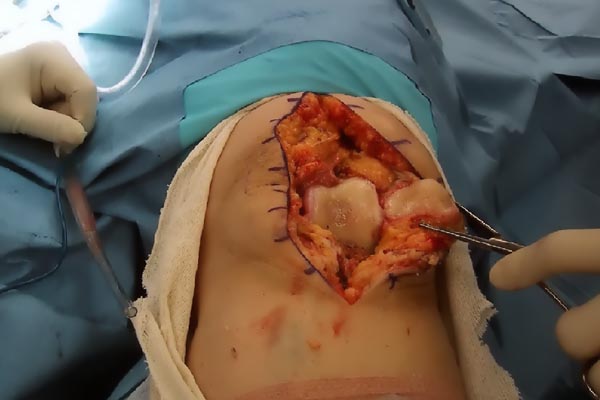 What happens in a total knee arthroplasty procedure?